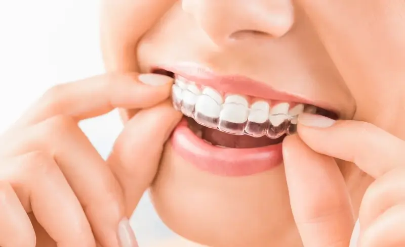 Invisalign co to znaczy?