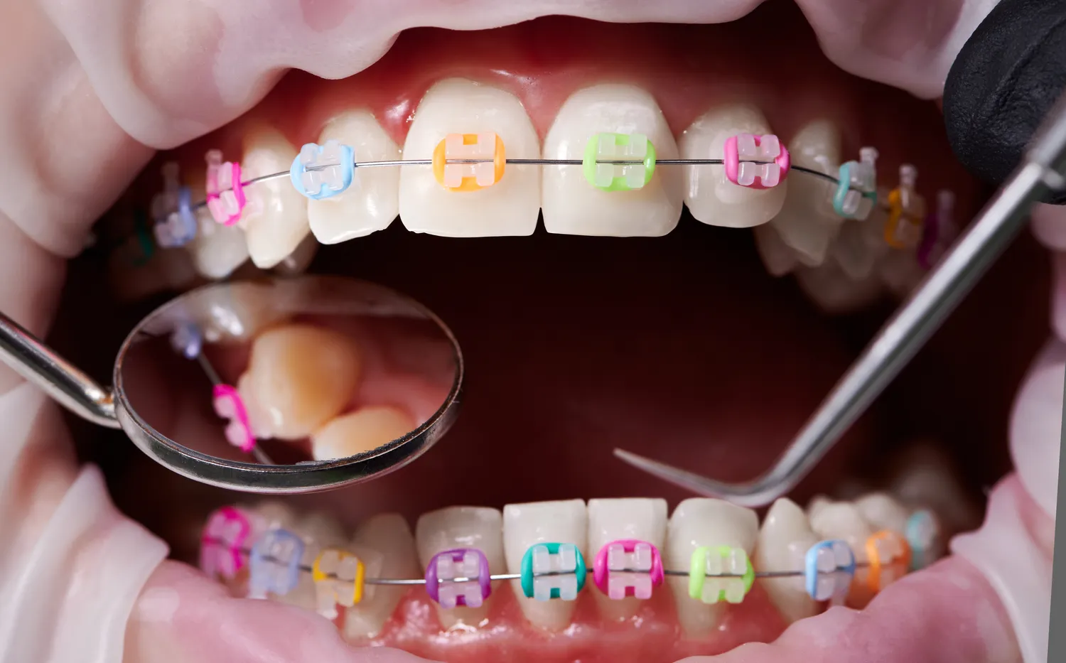 Implanty zębowe - proces zakładania implantu zębowego