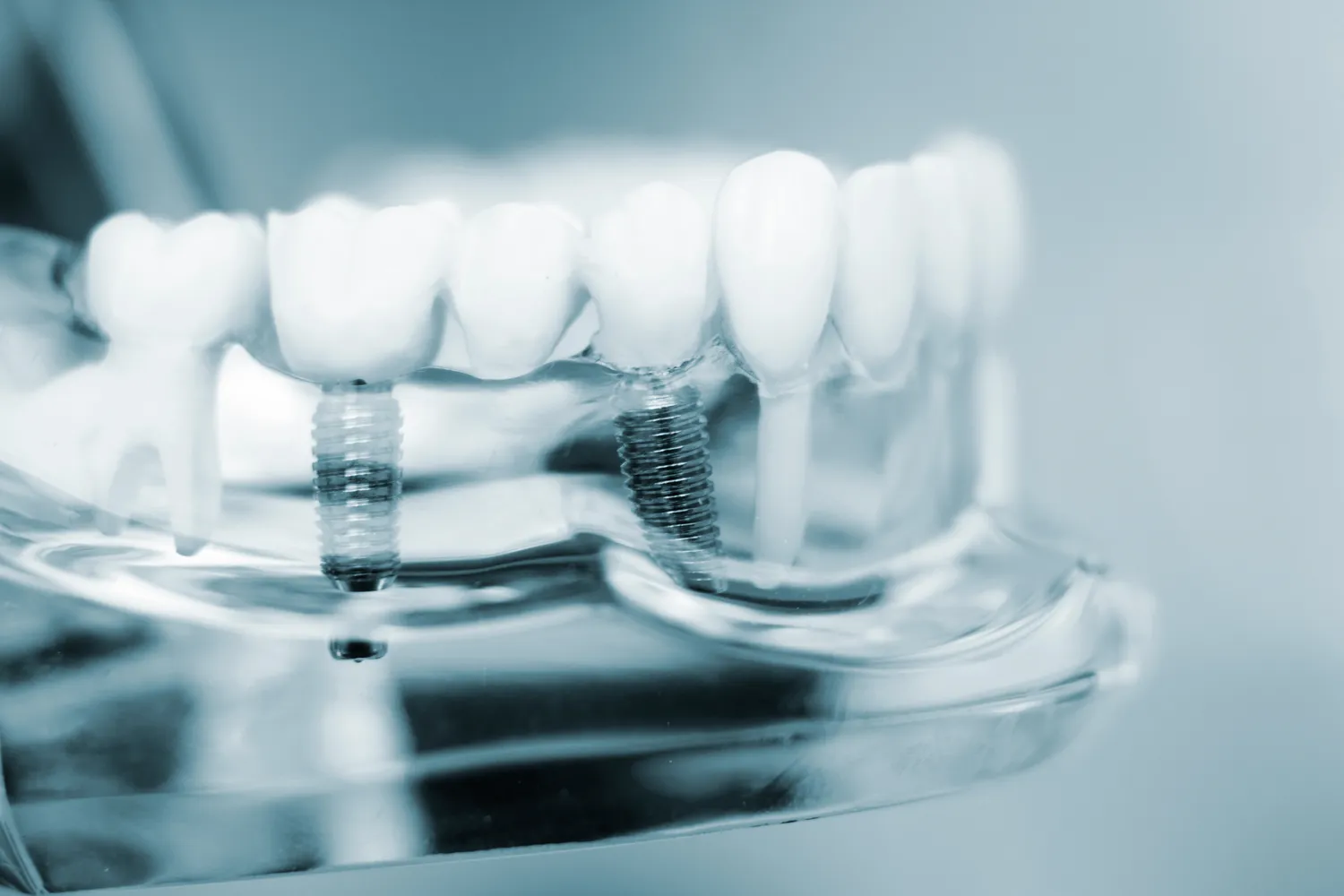 Rodzaje implantów zębowych